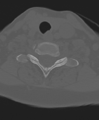 Cervical spine ACDF loosening (Radiopaedia 48998-54071 Axial bone window 46).png
