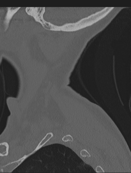 File:Cervical spondylolysis (Radiopaedia 49616-54811 Sagittal bone window 5).png