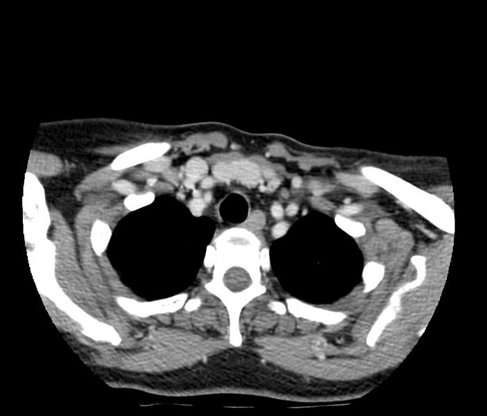 File:Cervical venous malformation (Radiopaedia 22653-22672 Axial C+ delayed 58).jpg