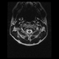Cervical vertebrae metastasis (Radiopaedia 78814-91667 Axial T2 21).png