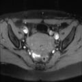 Cesarian section scar endometriosis (Radiopaedia 66520-75799 Axial T1 fat sat 12).jpg