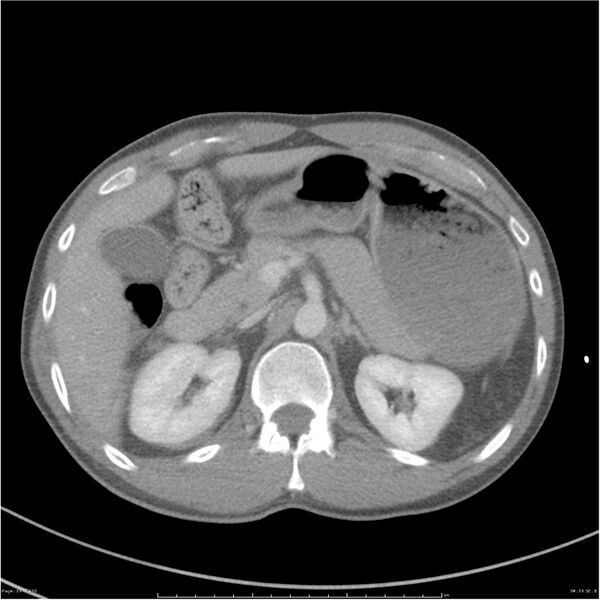 File:Chest and abdomen multi-trauma (Radiopaedia 26294-26426 bone window 29).jpg