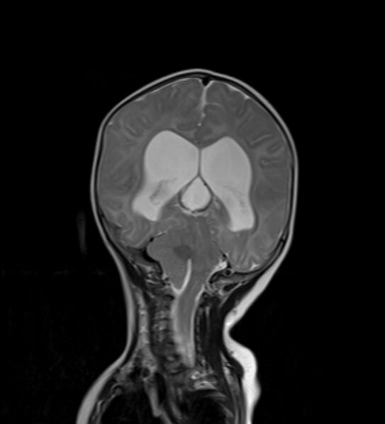 File:Chiari III malformation with occipital encephalocele (Radiopaedia 79446-92559 Coronal T2 19).jpg