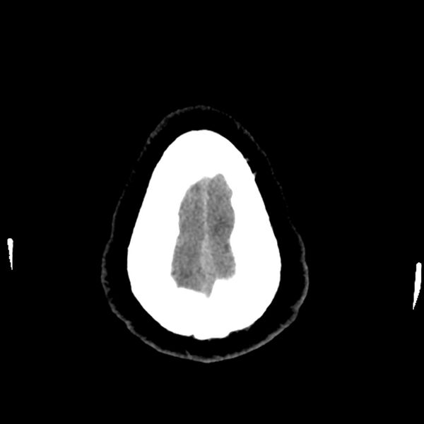File:Chiasmatic-hypothalamic juvenile pilocytic astrocytoma (Radiopaedia 78533-91237 Axial non-contrast 53).jpg