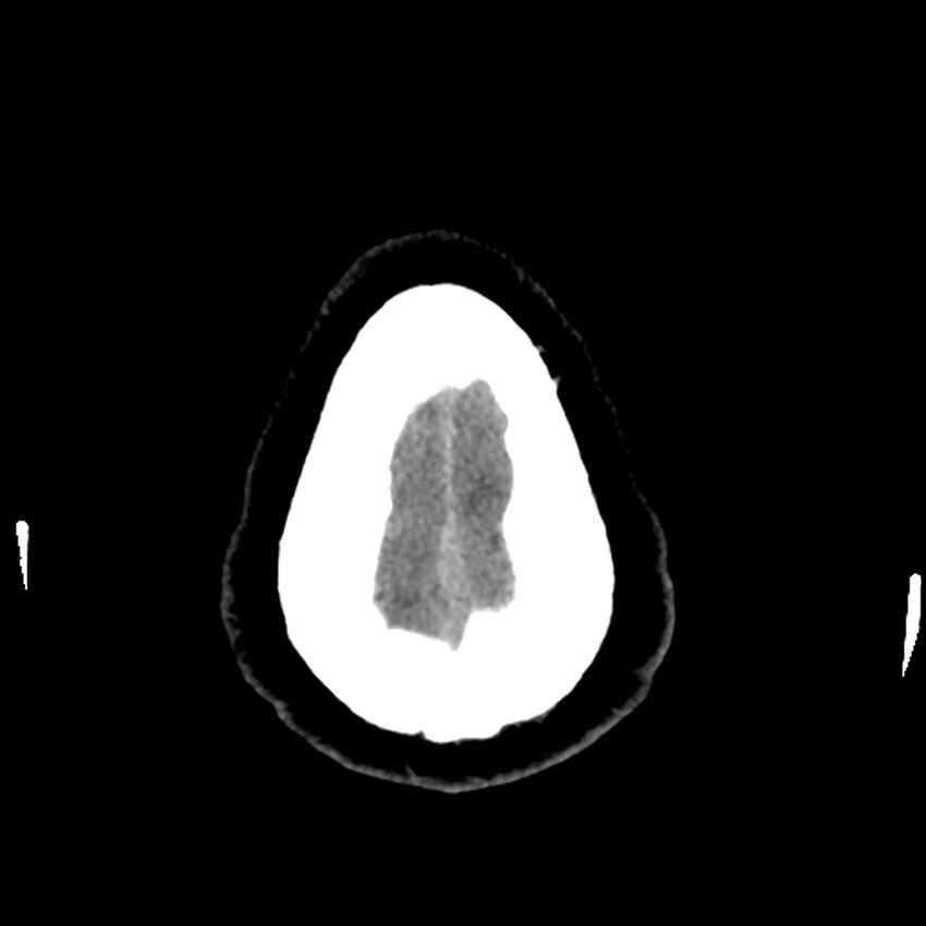Chiasmatic-hypothalamic juvenile pilocytic astrocytoma (Radiopaedia 78533-91237 Axial non-contrast 53).jpg