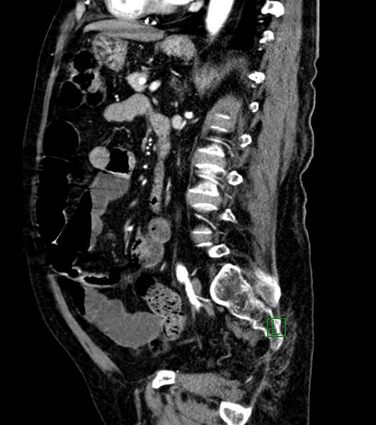 File:Cholangiocarcinoma with cerebral metastases (Radiopaedia 83519-98629 F 52).jpg