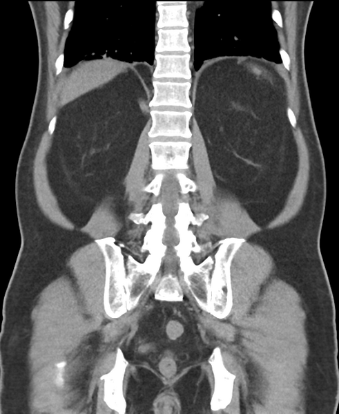 File:Cholecystitis with focal perforation and hepatic abscess (Radiopaedia 37189-38945 Coronal non-contrast 44).png