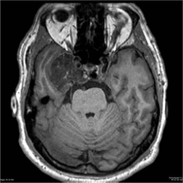 File:Chondrosarcoma of skull base- grade II (Radiopaedia 40948-43654 Axial T1 42).jpg