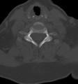 Chordoma (C4 vertebra) (Radiopaedia 47561-52188 Axial bone window 36).png