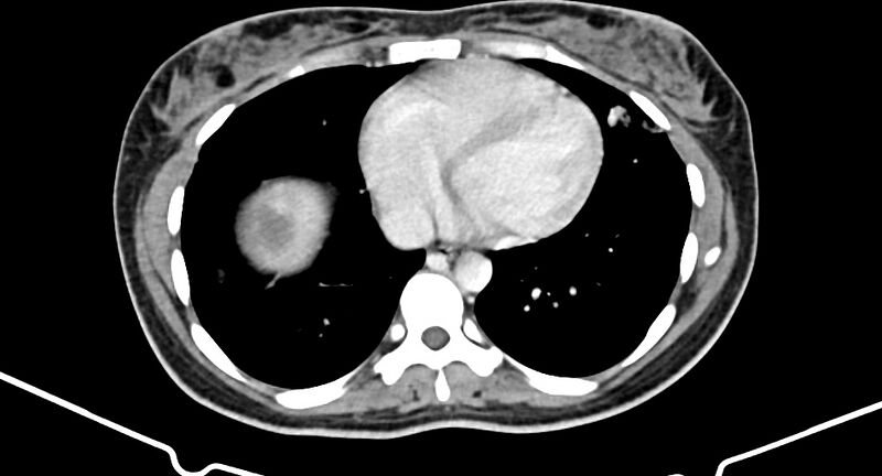 File:Choriocarcinoma liver metastases (Radiopaedia 74768-85766 A 15).jpg