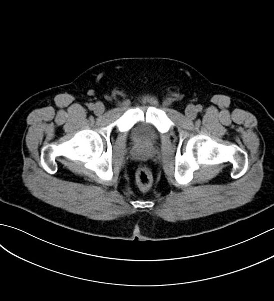 File:Chromophobe renal cell carcinoma (Radiopaedia 84286-99573 Axial non-contrast 65).jpg