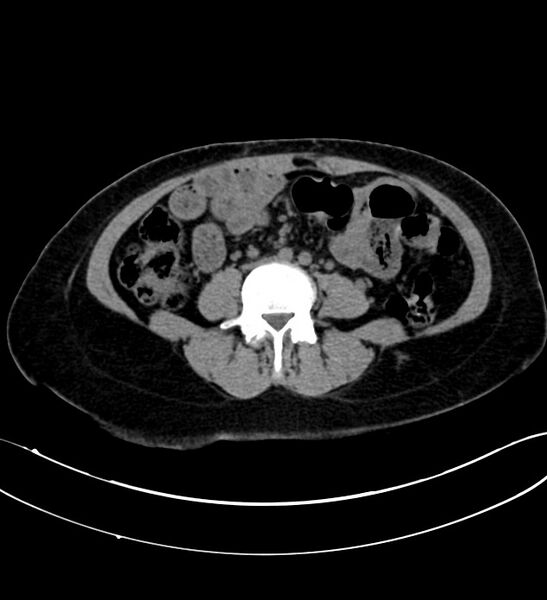 File:Chromophobe renal cell carcinoma (Radiopaedia 84290-99582 Axial non-contrast 87).jpg