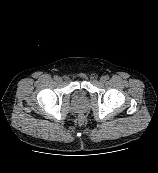 File:Chromophobe renal cell carcinoma (Radiopaedia 84337-99693 Axial non-contrast 158).jpg