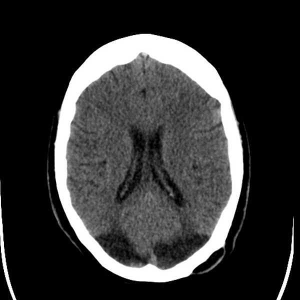 File:Chronic bilateral occipital lobe infarcts (Radiopaedia 31276-31996 Axial non-contrast 26).jpg