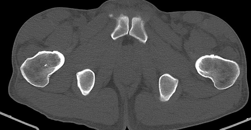 File:Chronic osteomyelitis (with sequestrum) (Radiopaedia 74813-85822 Axial non-contrast 48).jpg