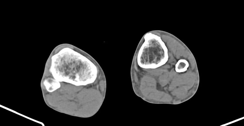Chronic osteomyelitis (with sequestrum) (Radiopaedia 74813-85822 D 206).jpg