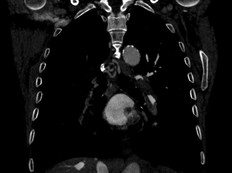 File:Chronic pulmonary embolism (Radiopaedia 91241-108843 A 66).jpg