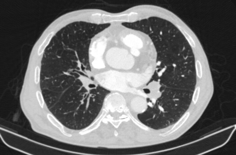 File:Chronic pulmonary embolism (Radiopaedia 91241-108843 Axial lung window 51).jpg