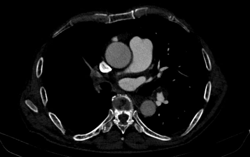 File:Chronic pulmonary embolism (Radiopaedia 91241-108843 B 95).jpg