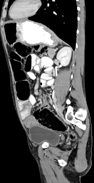 File:Chronic small bowel volvulus (Radiopaedia 75224-86322 C 57).jpg