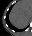 Chronic subcapsular hepatic hematoma (Radiopaedia 29548-30051 F 1).jpg