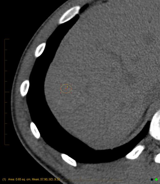 File:Chronic subcapsular hepatic hematoma (Radiopaedia 29548-30051 F 1).jpg