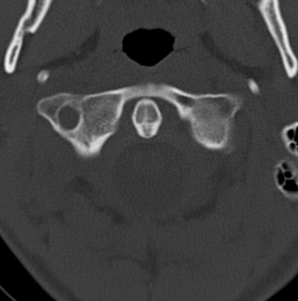 File:Cleft of the posterior arch of C1 mimicking fracture (Radiopaedia 40201-42721 Axial bone window 16).jpg