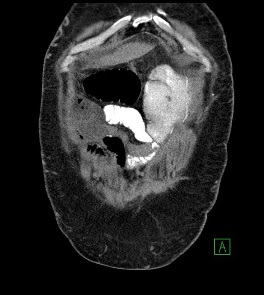 File:Closed-loop small bowel obstruction-internal hernia (Radiopaedia 78439-91096 Coronal non-contrast 21).jpg
