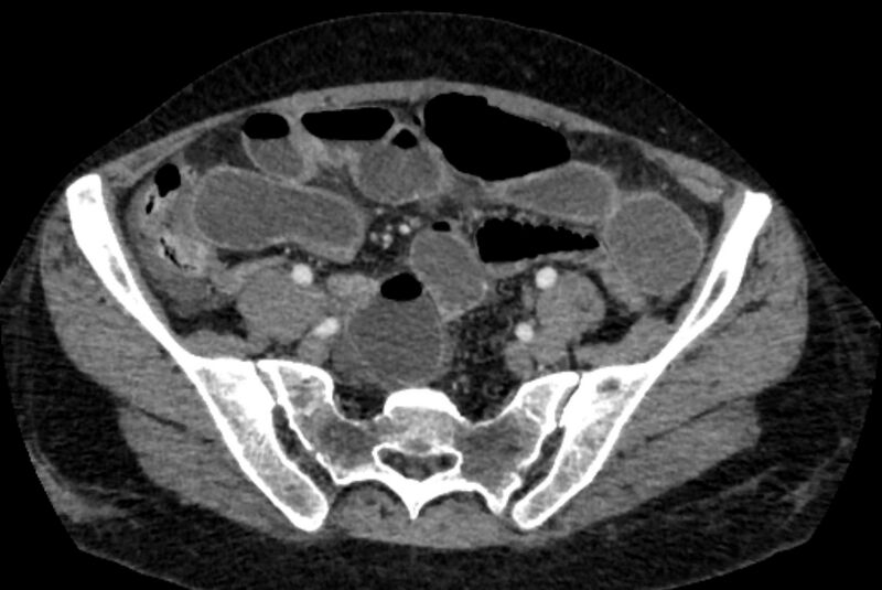 File:Closed loop small bowel obstruction (Radiopaedia 71211-81508 A 112).jpg