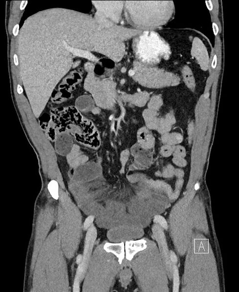 File:Closed loop small bowel obstruction - internal hernia (Radiopaedia 57806-64778 A 46).jpg