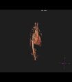 Coarctation of the aorta (Radiopaedia 43373-46729 3D reconstruction 31).jpg