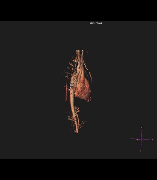 File:Coarctation of the aorta (Radiopaedia 43373-46729 3D reconstruction 31).jpg