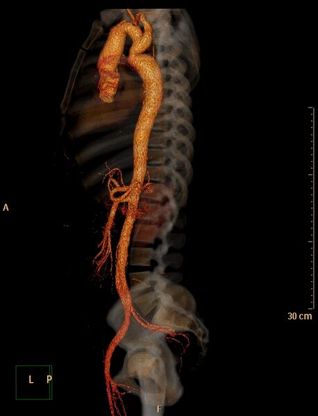 File:Coarctation of the aorta (Radiopaedia 49784-55050 3D VRT 17).jpg