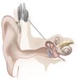 Cochlear implant (illustration) (Radiopaedia 36338).jpg