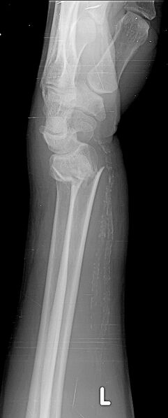 File:Colles fracture (Radiopaedia 69315-79142 Lateral 1).jpg