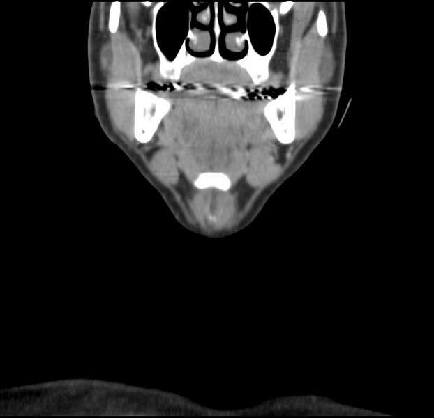 File:Colloid cyst of thyroid (Radiopaedia 22897-22923 Coronal C+ delayed 17).jpg