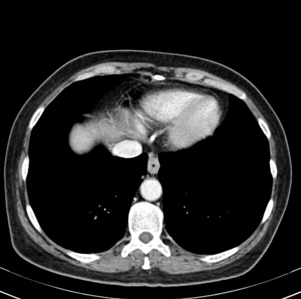File:Colon carcinoma with hepatic metastases (Radiopaedia 29477-29961 A 9).jpg