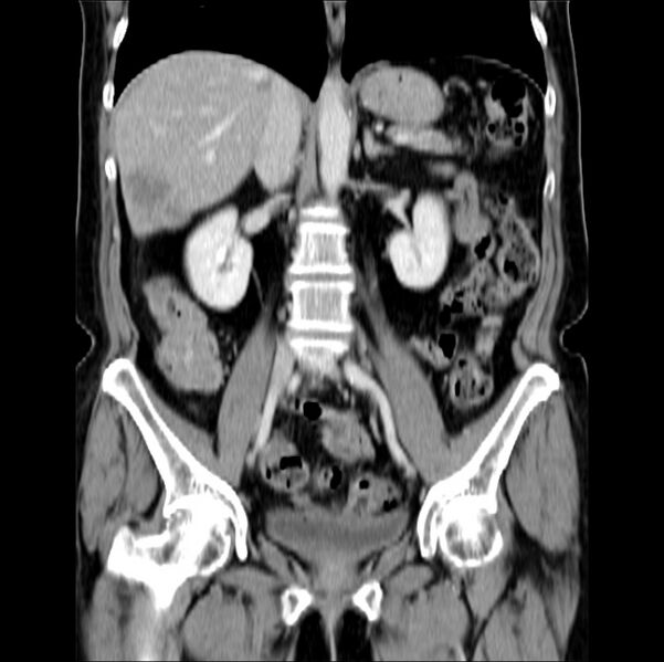File:Colon carcinoma with hepatic metastases (Radiopaedia 29477-29961 B 24).jpg