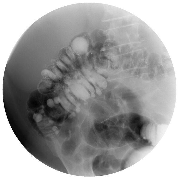 File:Colonic diverticulosis on single and double contrast barium enema (Radiopaedia 42254-45340 Double contrast 5).jpg