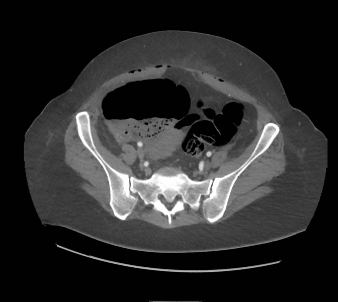 File:Colonic pseudo-obstruction (Radiopaedia 79752-92980 A 143).png