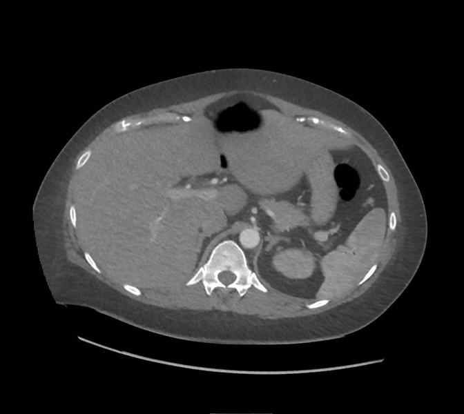 File:Colonic pseudo-obstruction (Radiopaedia 79752-92980 A 48).png