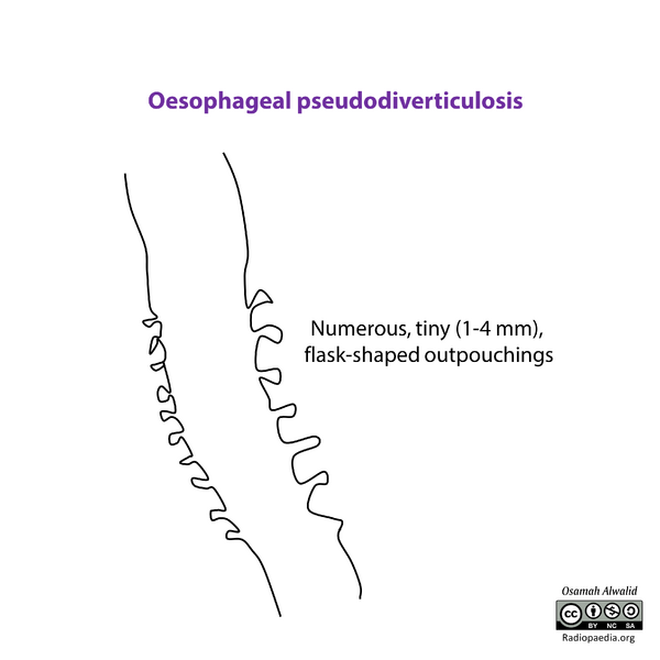 File:Esophageal pseudodiverticulosis (illustration) (Radiopaedia 60619).png