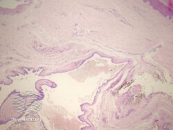 pathology-Cutaneous ciliated cyst
