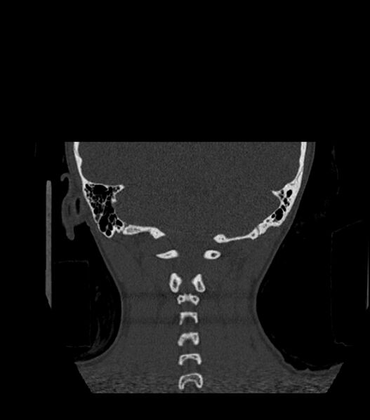 File:Nasoorbitoethmoid fracture (Radiopaedia 90044-107205 Coronal bone window 122).jpg