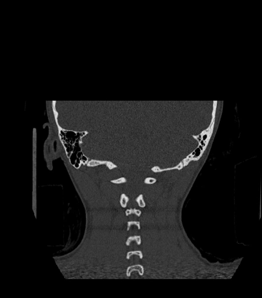 Nasoorbitoethmoid fracture (Radiopaedia 90044-107205 Coronal bone window 122).jpg