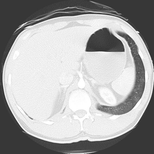 File:Near drowning pulmonary edema (Radiopaedia 16868-16591 Axial lung window 53).jpg