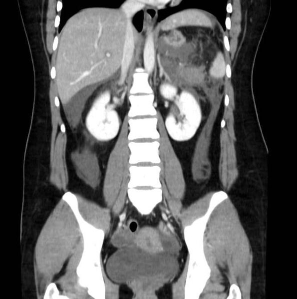 File:Necrotizing pancreatitis (Radiopaedia 23001-23031 B 41).jpg