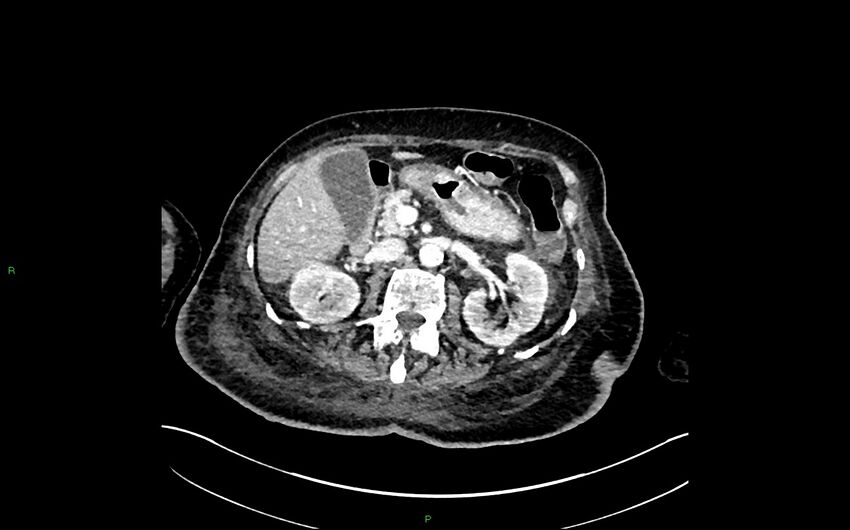 Neo-terminal ileal stricture (Crohn disease) (Radiopaedia 33790-34948 A 153).jpg
