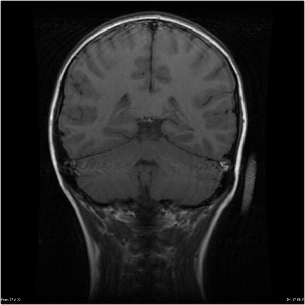 File:Neurofibromatosis type 1 (Radiopaedia 22541-22564 Coronal T1 36).jpg