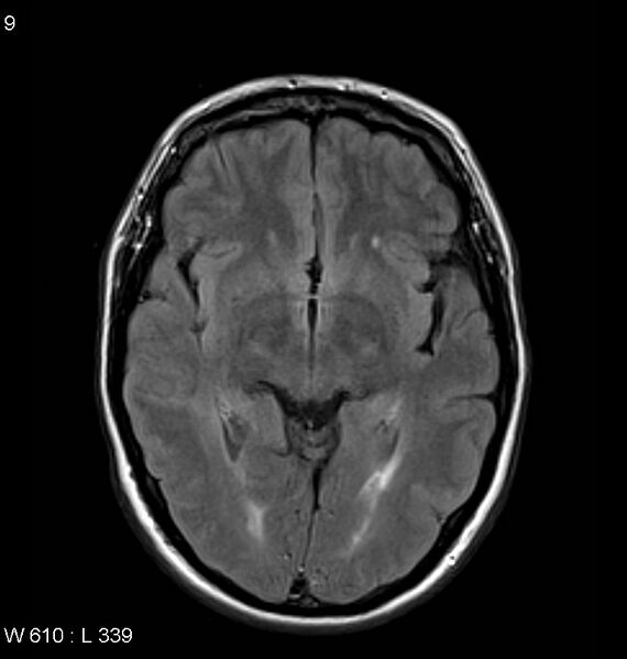 File:Neurosarcoidosis (Radiopaedia 10930-11351 Axial FLAIR 9).jpg